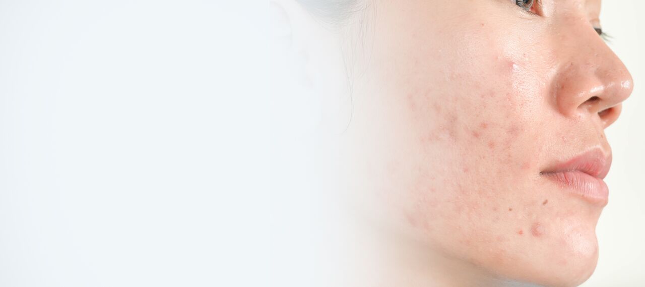 Acne Scars San Diego, CA Cosmetic Laser Dermatology