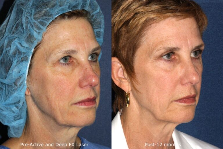 Before and after oblique image of Active/DeepFX treatment on a female's face performed by Dr. Goldman at our San Diego medical clinic