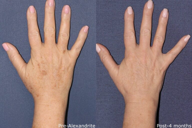 Before and after front image of Alexandrite laser treatment on a female's hands performed by Dr. Fabi at our San Diego medical spa