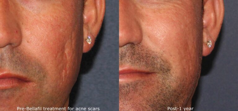 Before and after front image of Bellafill treatment on a male's midface performed by Dr. Wu at our San Diego medical spa
