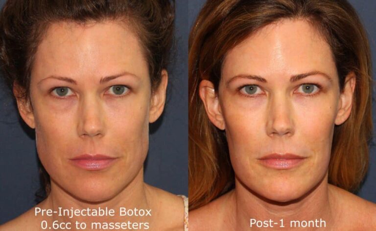 Before and after front image of Botox treatment on a female's masseter muscles performed by Dr. Groff at our San Diego medical clinic