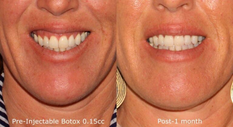 Before and after front image of Botox treatment on a female's gummy smile performed by Dr. Wu at our San Diego medical spa