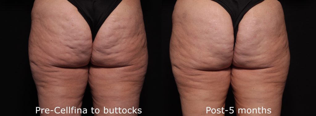 Buttock Enhancement 