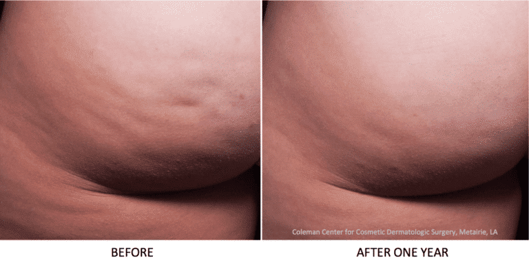 Before and after oblique image of Cellfina treatment on a female's buttocks performed by Dr. Fabi at our San Diego med spa