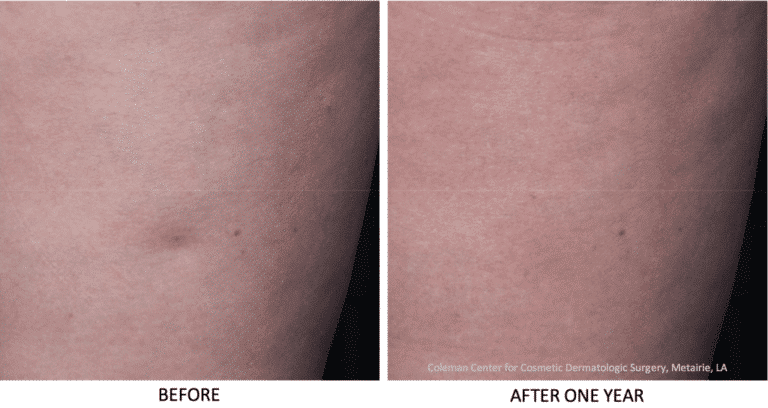 Before and after back image of Cellfina treatment on a female's thigh performed by Dr. Fabi at our San Diego med spa