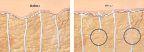cellulite before and after cellfina