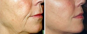 image showing cheeks of a woman regained their lost volume and decreased collagen after sculptra San Diego, CA