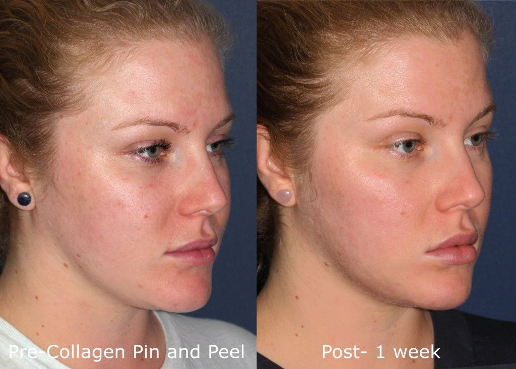 Chemical Peel Facial Packages