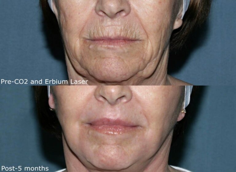 Before and after front image of CO2 and erbium laser treatment on a female's mouth wrinkles performed by Dr. Groff at our San Diego medical spa