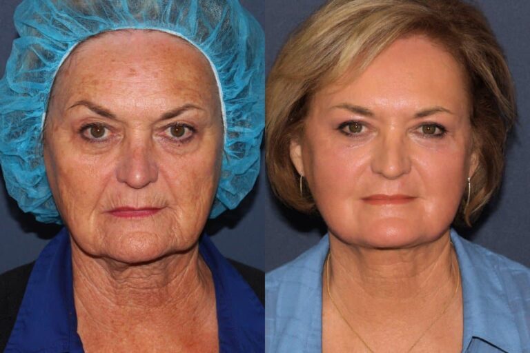 Before and after UltraPulse CO2 laser resurfacing, showing dramatic reduction in deep wrinkles and improved skin texture.