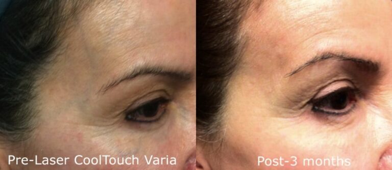 Before and after oblique image of CoolTouch Varia treatment on a female's veins around the eyes performed by Dr. Groff at our San Diego medical spa