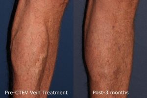 Cooltouch CTEV Vein Treatment San Diego