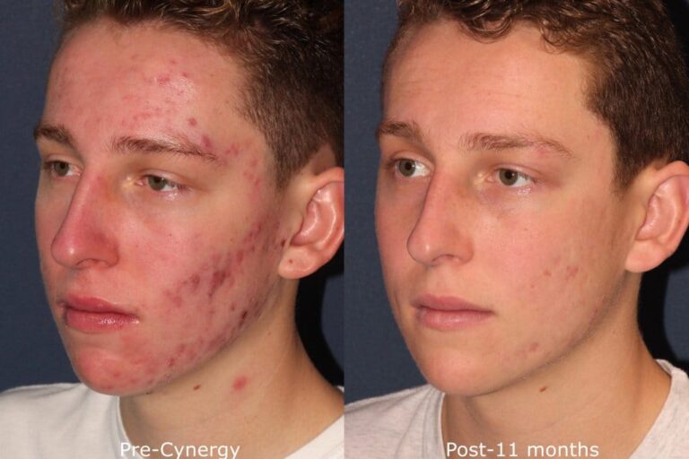 Before and after oblique image of Cynergy laser treatment on a male's face to treat acne performed by Dr. Goldman at our San Diego medical spa