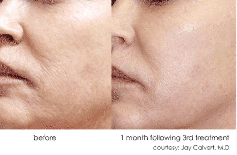 dermasweep wrinkle reduction la jolla