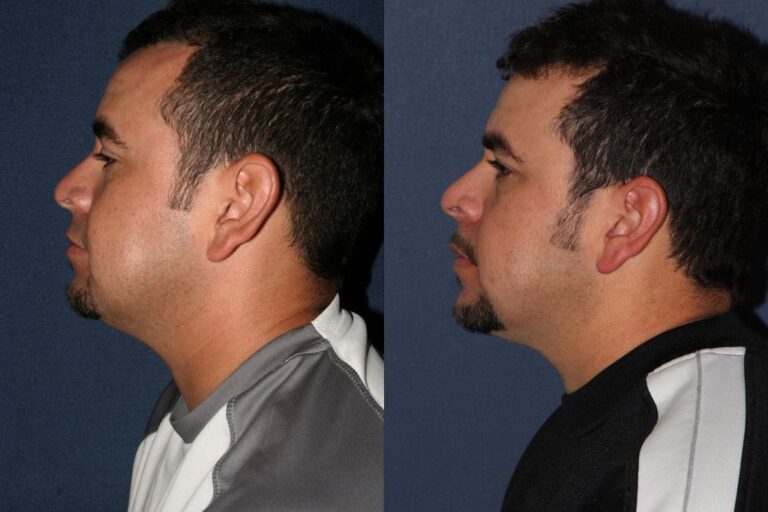 Before and after side image of Kybella treatment on a male's submental fat performed by Dr. Fabi at our San Diego med spa