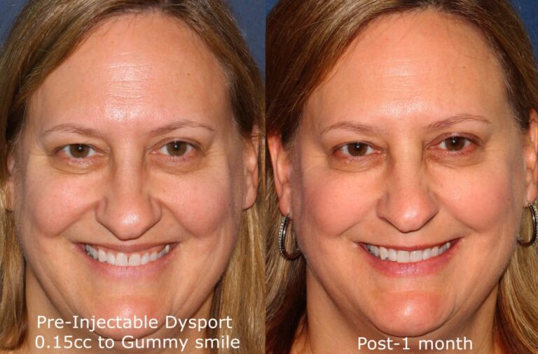 Before and after front image of Dysport treatment on a female's gummy smile performed by Dr. Fabi at our San Diego medical spa