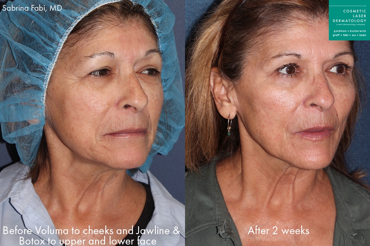 before and after voluma to treat ethnic skin concerns in san diego, CA