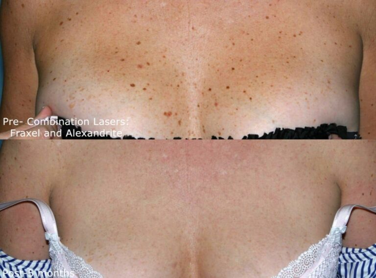 Before and after front image of Fraxel and Alexandrite laser treatment on a female's chest performed by Dr. Groff at our San Diego medical clinic