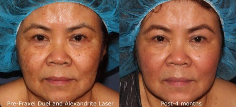 Before and after front image of Fraxel Dual and Alexandrite laser treatment on a female's face performed by Dr. Groff at our San Diego medical spa