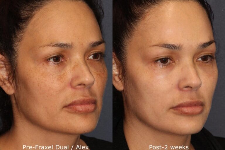 Before and after oblique image of Fraxel Dual laser treatment on a female's face performed by Dr. Groff at our San Diego medical spa