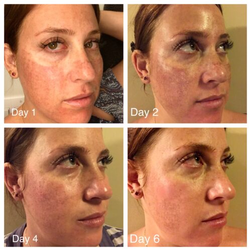 fractional skin resurfacing healing day by day