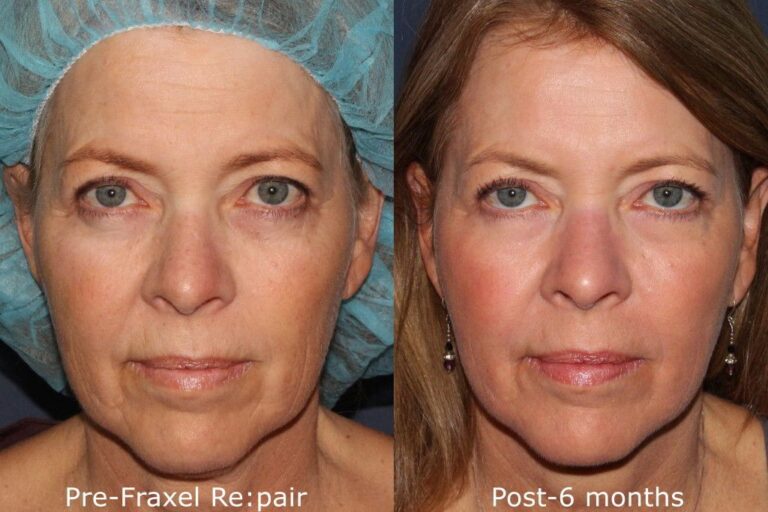 Before and after front image of Fraxel Re:pair laser treatment on a female's face performed by Dr. Groff at our San Diego medical spa