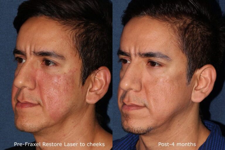 Before and after oblique image of Fraxel Restore laser treatment on a male's face performed by Dr. Fabi at our San Diego medical spa