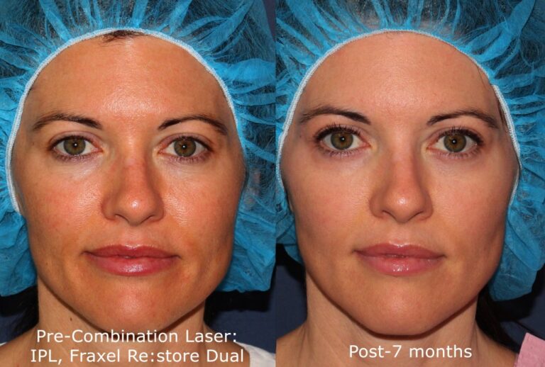 Before and after front image of IPL and Fraxel Restore laser treatment on a female's face performed by Dr. Fabi at our San Diego med spa