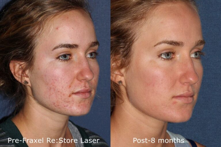 Before and after oblique image of Fraxel Re:store treatment on a female's face performed by Dr. Fabi at our San Diego medical clinic