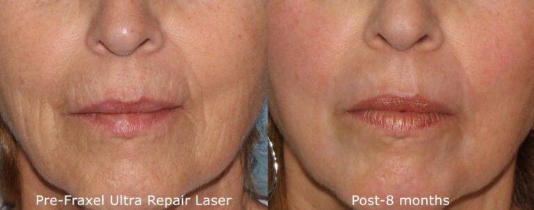 Before and after front image of Fraxel Re:pair laser treatment on a female's lip lines performed by Dr. Fabi at our San Diego medical spa