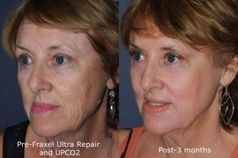 Before and after oblique image of Fraxel Re:pair treatment on a female's face performed by Dr. Groff at our San Diego medical spa