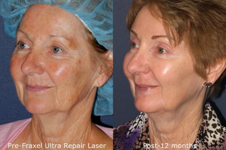 Before and after oblique image of Fraxel Re:pair treatment on a female's face performed by Dr. Groff at our San Diego medical spa