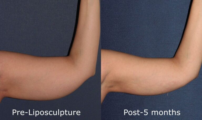 Before and after front image of liposculpture treatment on a female's arms performed by Dr. Goldman at our San Diego medi spa