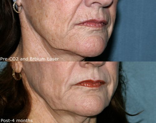 Before and after oblique image of CO2 and erbium laser treatment on a female's lip wrinkles performed by Dr. Groff at our San Diego medical spa