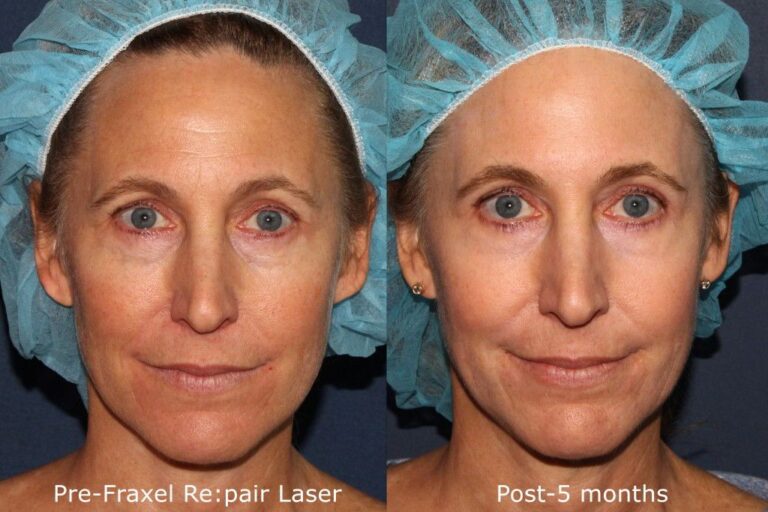 Before and after front image of Fraxel Re:pair laser treatment on a female's face performed by Dr. Groff at our San Diego medical spa