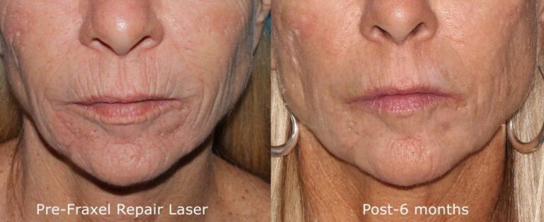 Before and after front image of Fraxel Re:pair laser treatment on a female's lip lines performed by Dr. Groff at our San Diego medical spa