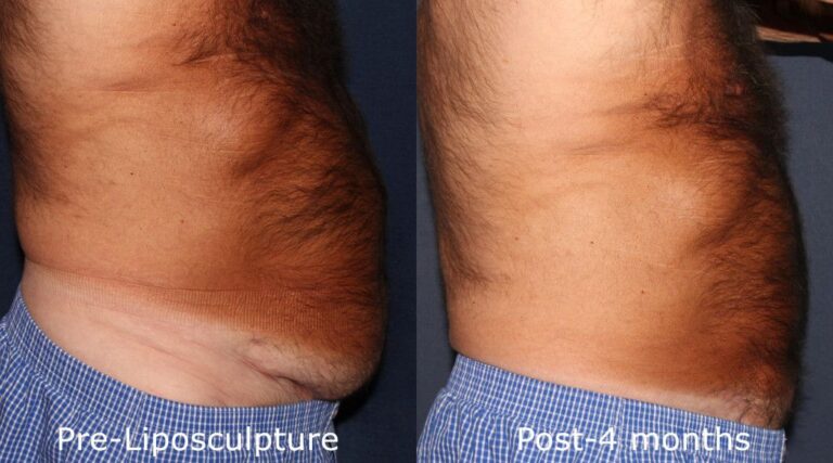 Before and after side image of liposculpture treatment on a male's abdomen performed by Dr. Groff at our San Diego med spa