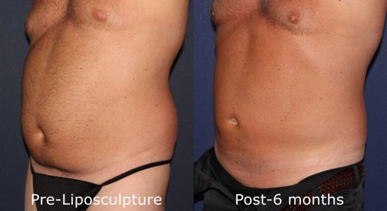 Before and after oblique image of liposculpture treatment on a male's abdomen performed by Dr. Groff at our San Diego medi spa