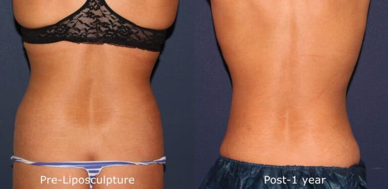 Before and after back image of liposculpture treatment on a female's back and love handles performed by Dr. Groff at our San Diego med spa