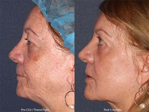 cosmetic laser dermatology thermitight before and after san diego ca