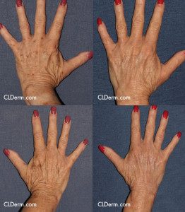 Before and after front image of laser treatment on a female's hands performed by Dr. Fabi at our San Diego medical spa