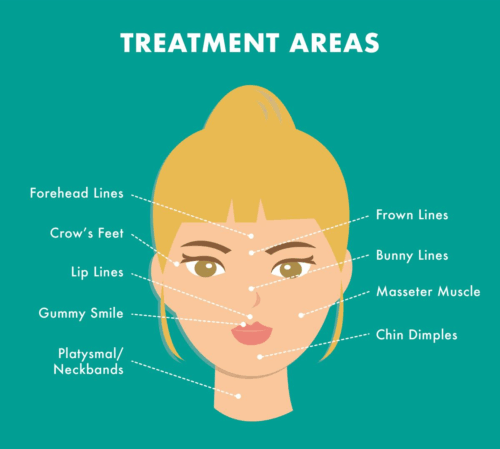 Infographic explaining treatment areas for Dysport in San Diego