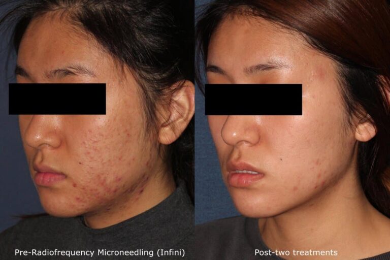Before and after oblique image of Infini RF microneedling treatment on a female's face performed by Dr. Wu at our San Diego medical spa