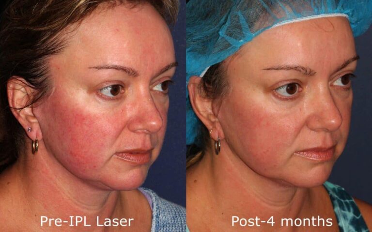 Before and after oblique image of IPL treatment on a female's facial redness performed by Dr. Fabi at our San Diego med spa