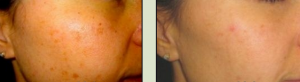 image showing facial dark spots that are removed after IPL laser treatment, San Diego, CA