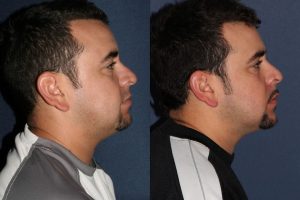 Before and after side image of Kybella treatment on a male's chin and neck performed by Dr. Fabi at our San Diego medical spa