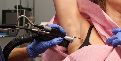 clderm laser hair removal under arms san diego ca