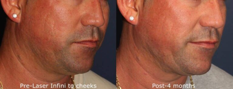 Microneedling Resurfacing Procedure La Jolla