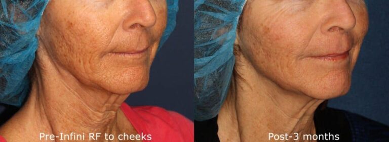 Laser Revitalizing Treatment San Diego