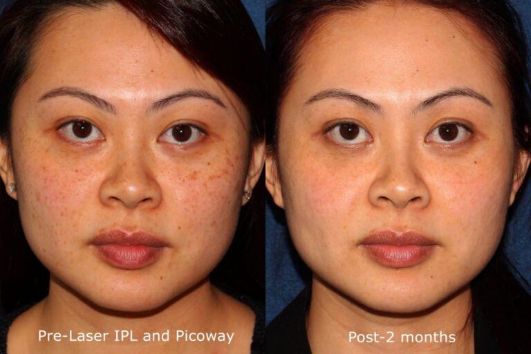 Before and after front image of IPL and PicoWay laser treatment on a female's face performed by Dr. Wu at our San Diego medical spa